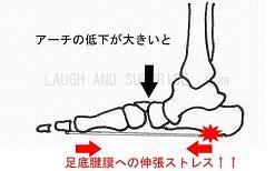 アーチ低下による足底腱膜の伸張.jpg