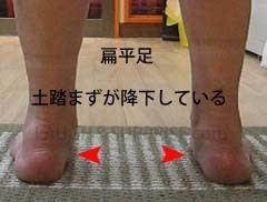 8．扁平足(へんぺいそく)とは