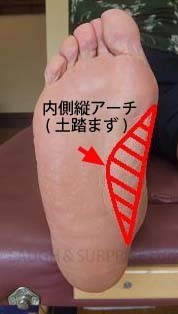 8．扁平足(へんぺいそく)とは
